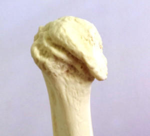 ESCAPULA RADIOPACA DIREITA COM OSTEOARTRITE - cód. 12349