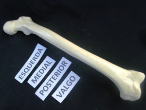 FEMUR ESQUERDO COM DEFORMIDADE EM DOIS PLANOS - cód. 2025 D2P