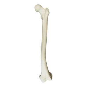 FEMUR DIREITO COM DEFORMIDADE DISTAL  SMA - cód. 2030 DD 