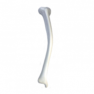 TIBIA RADIOPACA DIREITA COM DEFORMIDADE 2 PLANOS MEDIAL POSTERIOR VALGO - cód. 12434