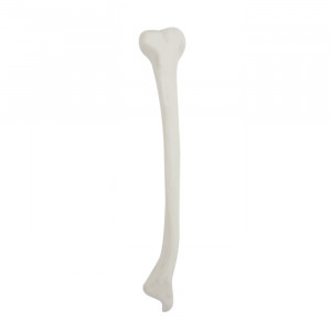 TÍBIA RADIOPACA DIREITA COM DEFORMIDADE DISTAL VALGO - cód. 12435