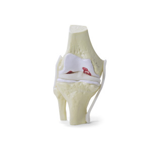 JOELHO COM OSTEOARTRITE MODERADO - cód. 9597-3