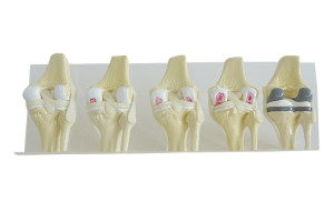 KIT DE JOELHOS COM OSTEOARTRITE (5 PEÇAS) - cód. 9597